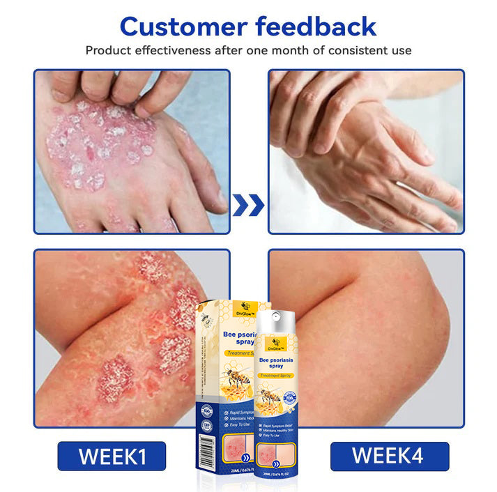 (🔥 70% off last day purchase 🔥) DivGlow™ PsoriaHeal psoriasis Spray🐝