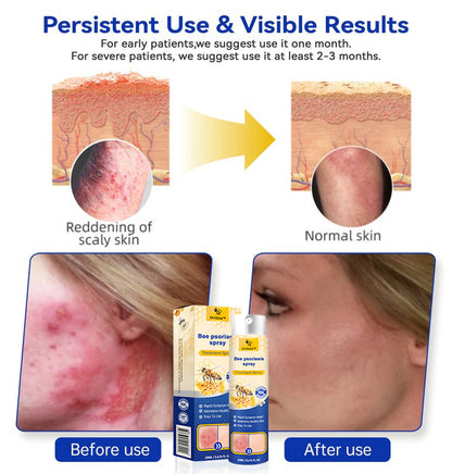 (🔥 70% off last day purchase 🔥) DivGlow™ PsoriaHeal psoriasis Spray🐝